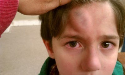 goose egg, knot on the head, head injury, child